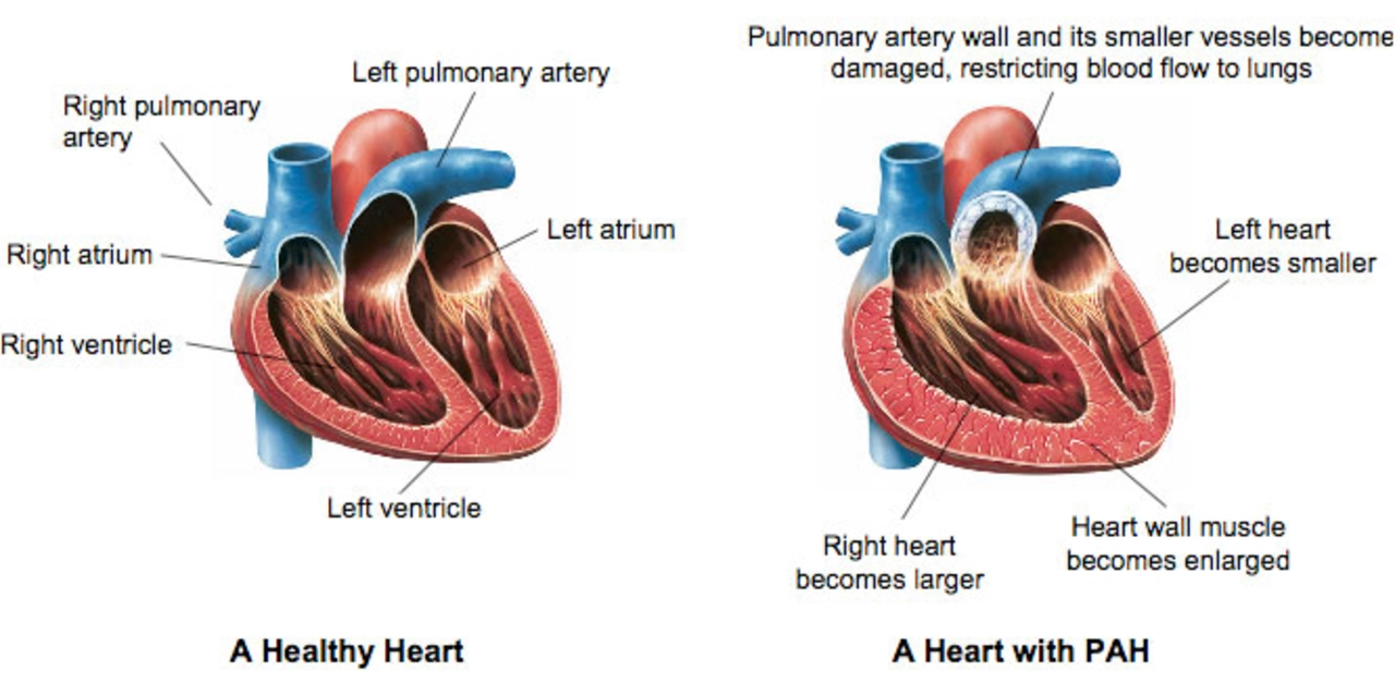 Ambrisentan and the Future of Pulmonary Arterial Hypertension Research