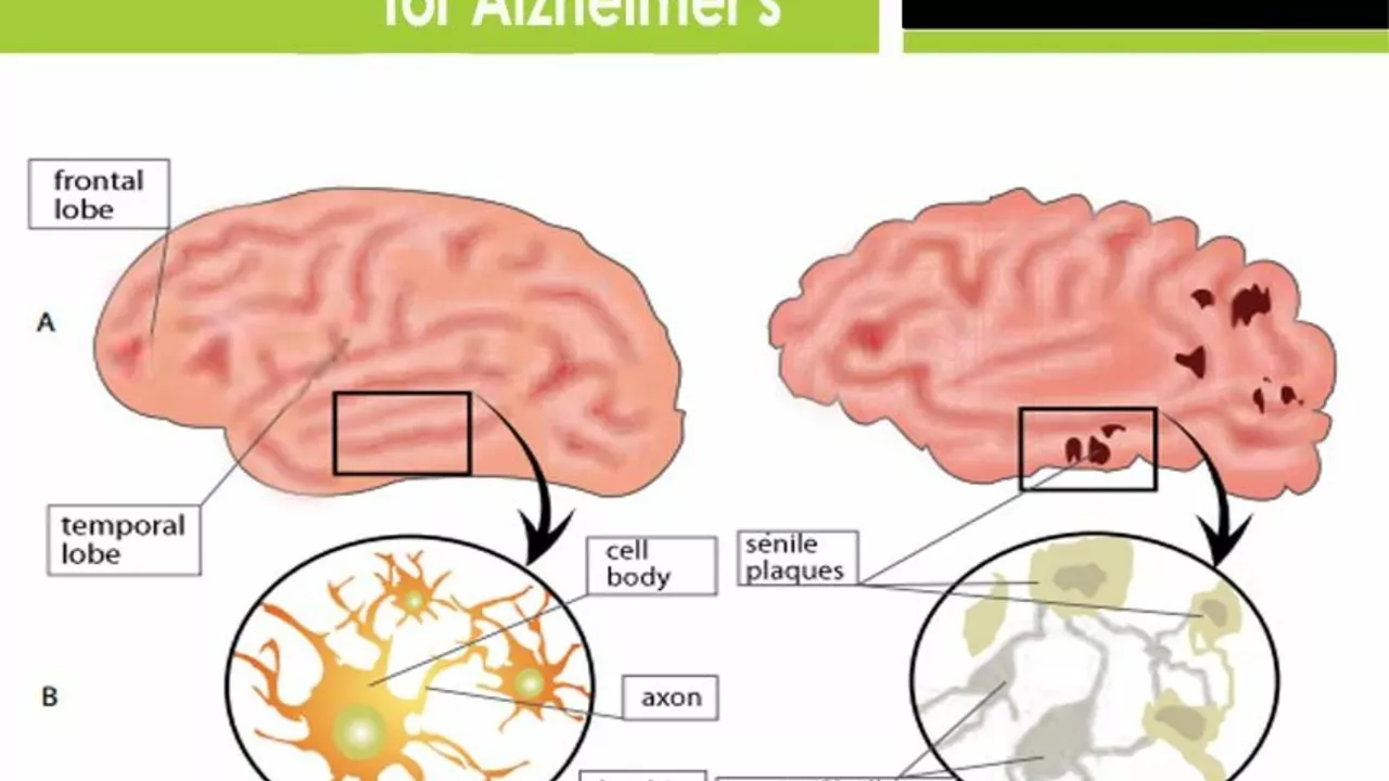 Memantine vs. Donepezil: Comparing Alzheimer's Treatments